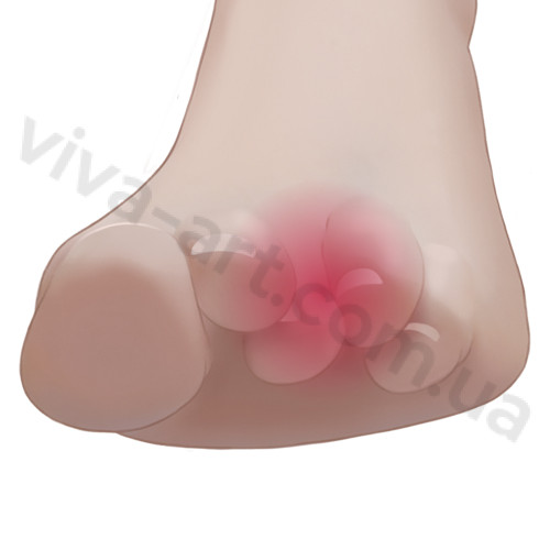 Кільце з гелю для вирівнювання молоткоподібних пальців, універсальний розмір, шт.